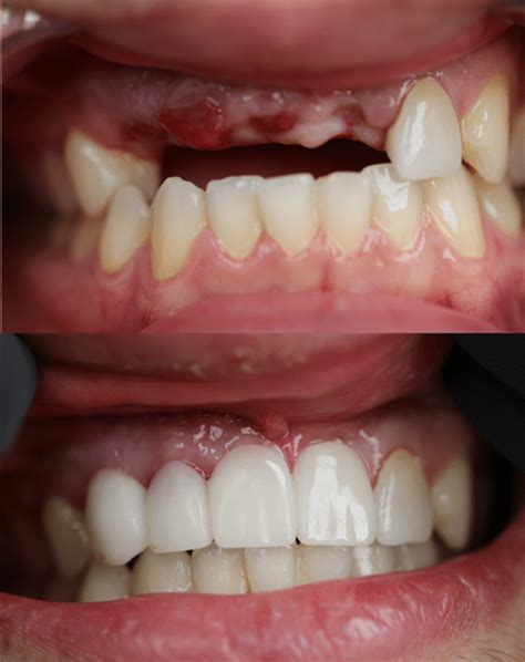 Tooth Implant Before After