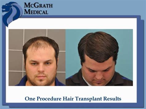 Before & After Hair Transplant Photos - Houston Hair Restoration