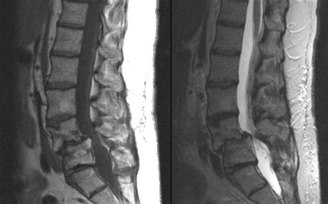 Severe Spinal Stenosis Mri - img-Abha