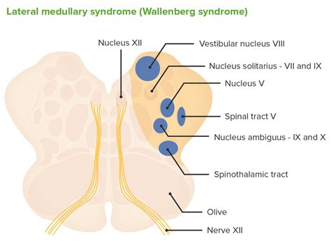 Lateral Medullary Syndrome (Wallenberg Syndrome) | Concise Medical Knowledge