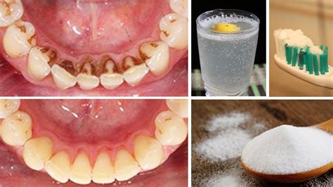 How To Remove Plaque From Teeth At Home Naturally #teeth #plaque