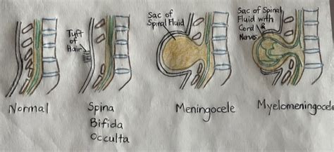 Spina Bifida Treatment - Physiotherapy for Kids (Singapore)