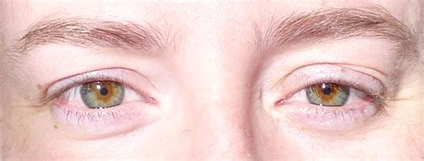 Bilateral central het | Different colored eyes, Heterochromia iridis, Central heterochromia