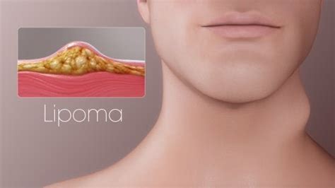 ¿Qué es un Lipoma? - Gastro-Cirugía - Blog