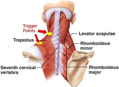 Painful knots in the muscles — Tinozzi Chiropractic Studio