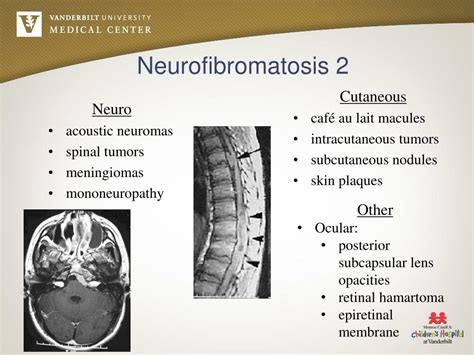 PPT - Neurocutaneous Disorders PowerPoint Presentation, free download - ID:4501574