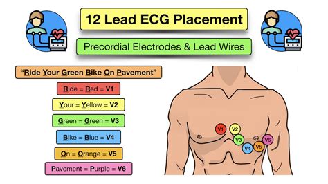 12 Lead ECG Placement: Diagram and Mnemonic for Limb and Precordial Electrode Location — EZmed