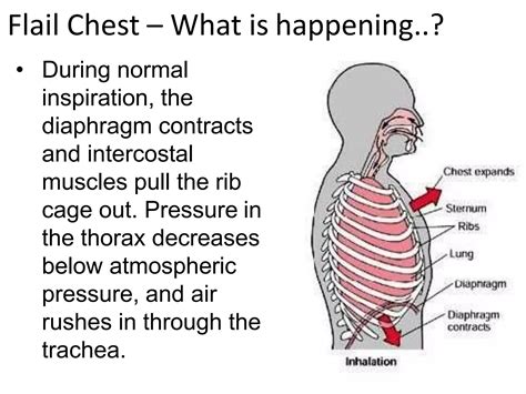 Flail chest | PPT | Free Download