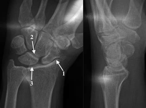 WRIST OSTEOARTHRITIS (Scapholunate Advanced Collapse) | Hand Surgery Source