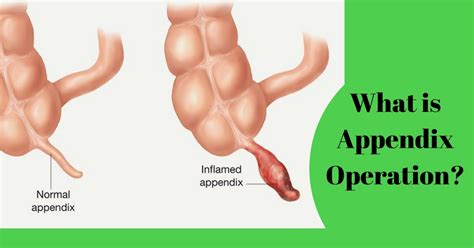 Appendix Removal Surgery in Chennai | Dr Maran Appendix Surgeon