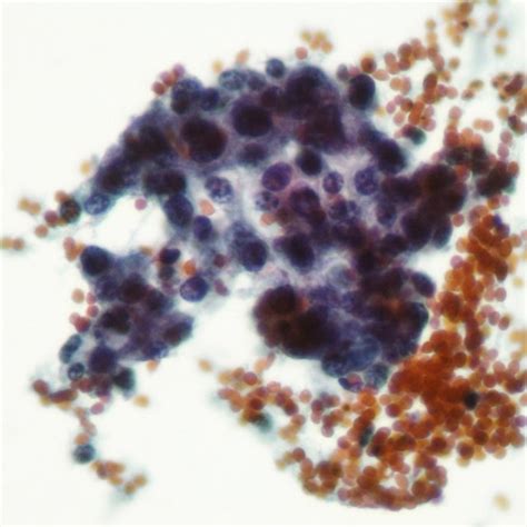 (PDF) LOW GRADE UROTHELIAL CARCINOMA; CYTOLOGICAL FEATURES DISCRIMINATING FROM ATYPICAL ...