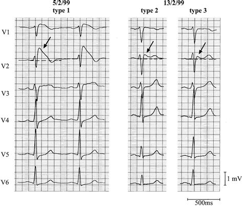 Brugada Syndrome Ekg Findings - Captions Hunter