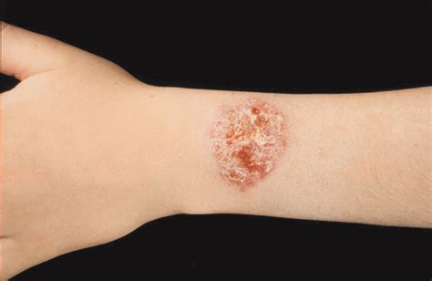 Diffuse Cutaneous Leishmaniasis