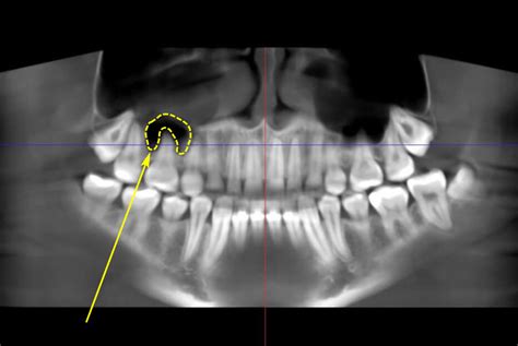 Odontogenic maxillary sinusitis: causes, symptoms, diagnosis, and treatment