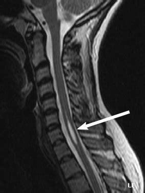 Syringomyelia - Wikipedia