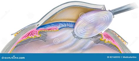 Eye - Cataract Surgery Step 1 Stock Illustration - Illustration of ...