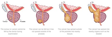 Prostate Cancers | Conditions | Bayside Urology | Queensland