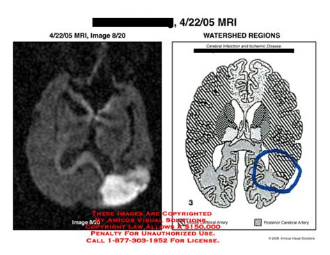 AMICUS Illustration of amicus,radiology,brain,mri,watershed,regions,diagram,infarct