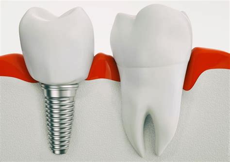 Single Tooth Implant - Dolphin Dental Group