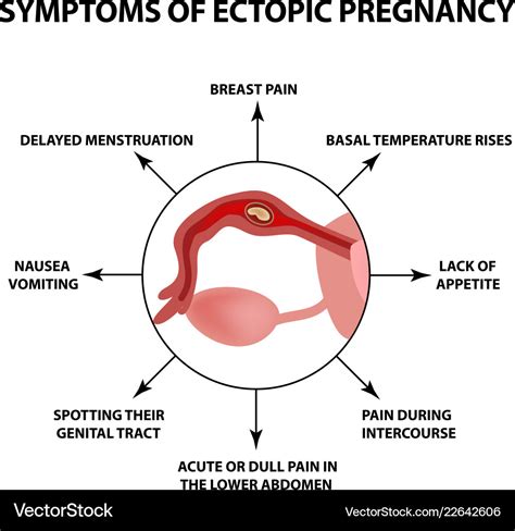 Symptoms ectopic pregnancy infographics Royalty Free Vector