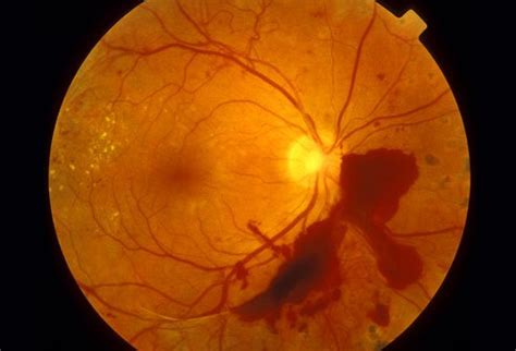 Diabetic Macular Oedema (Swelling) | myeyespecialist