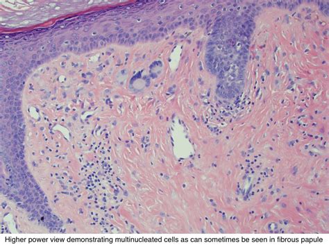 Pathology Outlines - Angiofibroma / fibrous papule