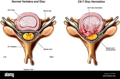 C6-7 Disc Herniation with Spinal Cord Compression Stock Photo: 7710010 - Alamy