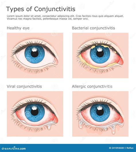 Types of Conjunctivitis Illustration Stock Vector - Illustration of eyes, redness: 241094608