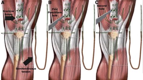 Surgical Treatment of Chronic Rupture of the Quadriceps Using a ...