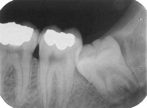 Easy Third-Molar Extractions - V4103 - Oral Surgery - CE Video Library