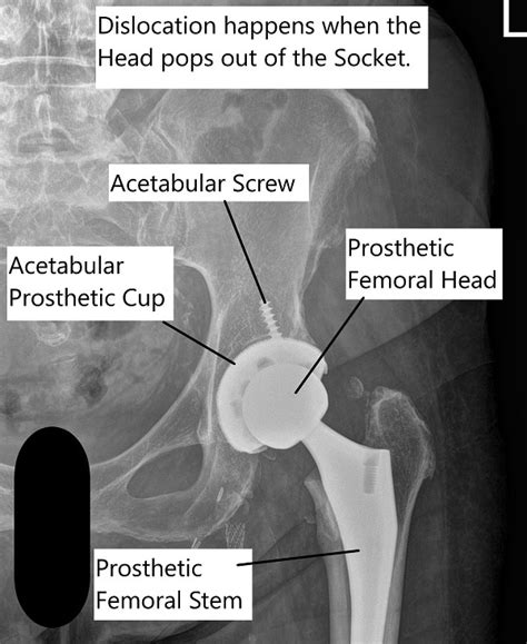 Total Hip Joint Dislocation - Complete Orthopedics & Podiatry ...