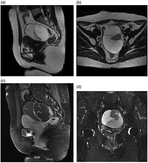 MRI findings showing a multiloculated cystic lesion measuring 7.5 Â 9.5 ...