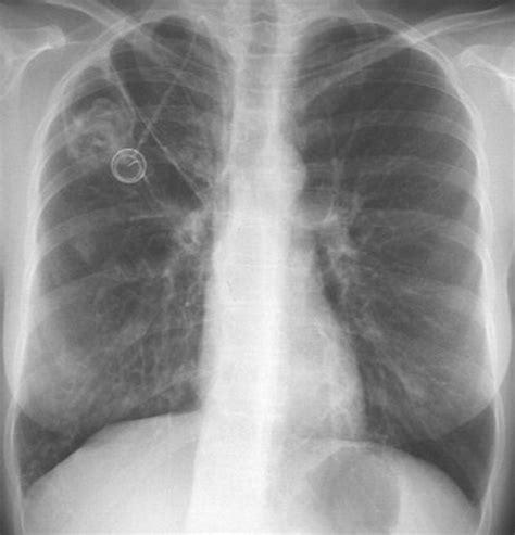 Multi–Detector Row CT of Hemoptysis | RadioGraphics