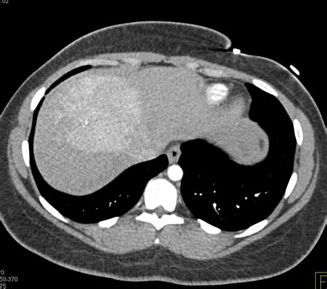 Focal Nodular Hyperplasia