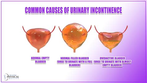 Explore the Symptom, Causes, and Treatments of Urinary Incontinence - Oklahoma Physical Therapy