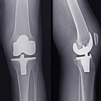 Knee Replacement Implant Types, Revision Surgery & Recalls