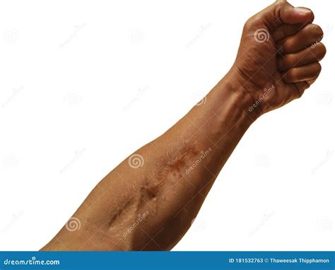 Scars on the Skin of the Arm Stock Image - Image of incision, patient: 181532763