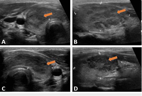 Thyroid ultrasound (US) showing heterogeneous diffuse goiter without... | Download Scientific ...