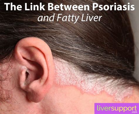 Psoriasis, NAFLD and Cirrhosis of the Liver - LiverSupport.com