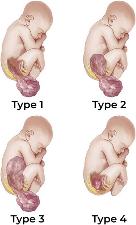 Sacrococcygeal teratoma types, cause, symptoms, diagnosis, treatment ...