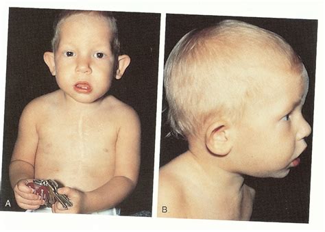 Medical Pictures Info – DiGeorge Syndrome