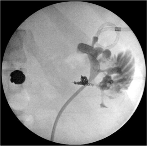 Left Retrograde Pyelogram with Fistula Left retrograde pyelogram ...