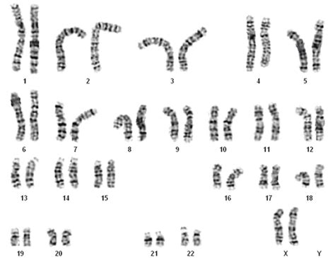 Karyotype showing normal female genotype with two X chromosome ...