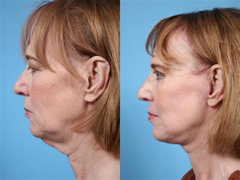 Neck Lift Before & After Photos Patient 68 | Chicago, IL | TLKM Plastic Surgery