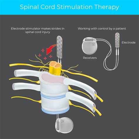 Spinal Cord Stimulator | AVALA Pain