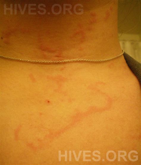 Hives Pictures - Photographs of Hives on Arms, Legs, Face, Hands, Feet ...