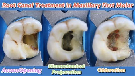 root canal treatment in maxillary first molar 🟢 endostar e3 azure 🟡mesiobuccal canals(mb1 and ...