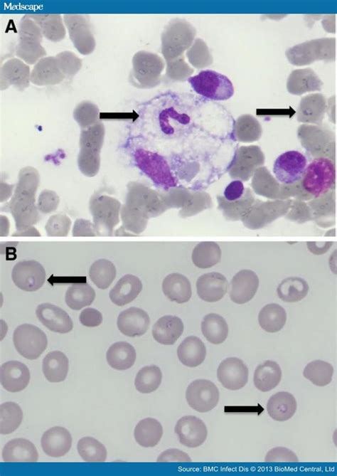 Babesia microti - Page 3