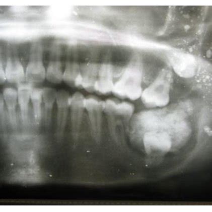 Photograph showing a large erupted odontome. | Download Scientific Diagram