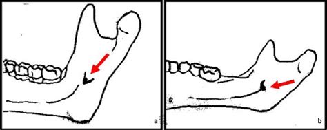 a-b: The arrow indicates the location of the mandibular foramen for an... | Download Scientific ...